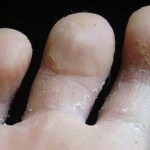 Фото: Грибок между пальцами ног
